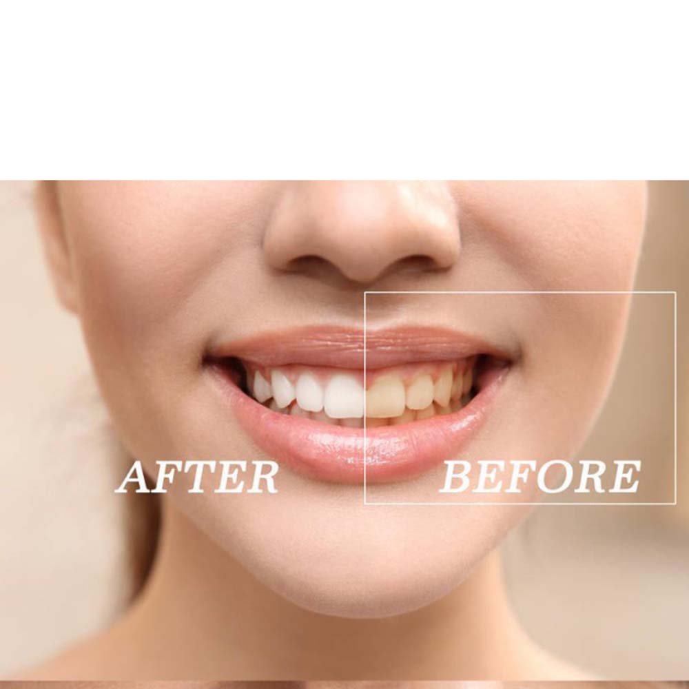 Высокое качество пероксид отбе – обзор и цена Teeth Whitening Kit With Light
