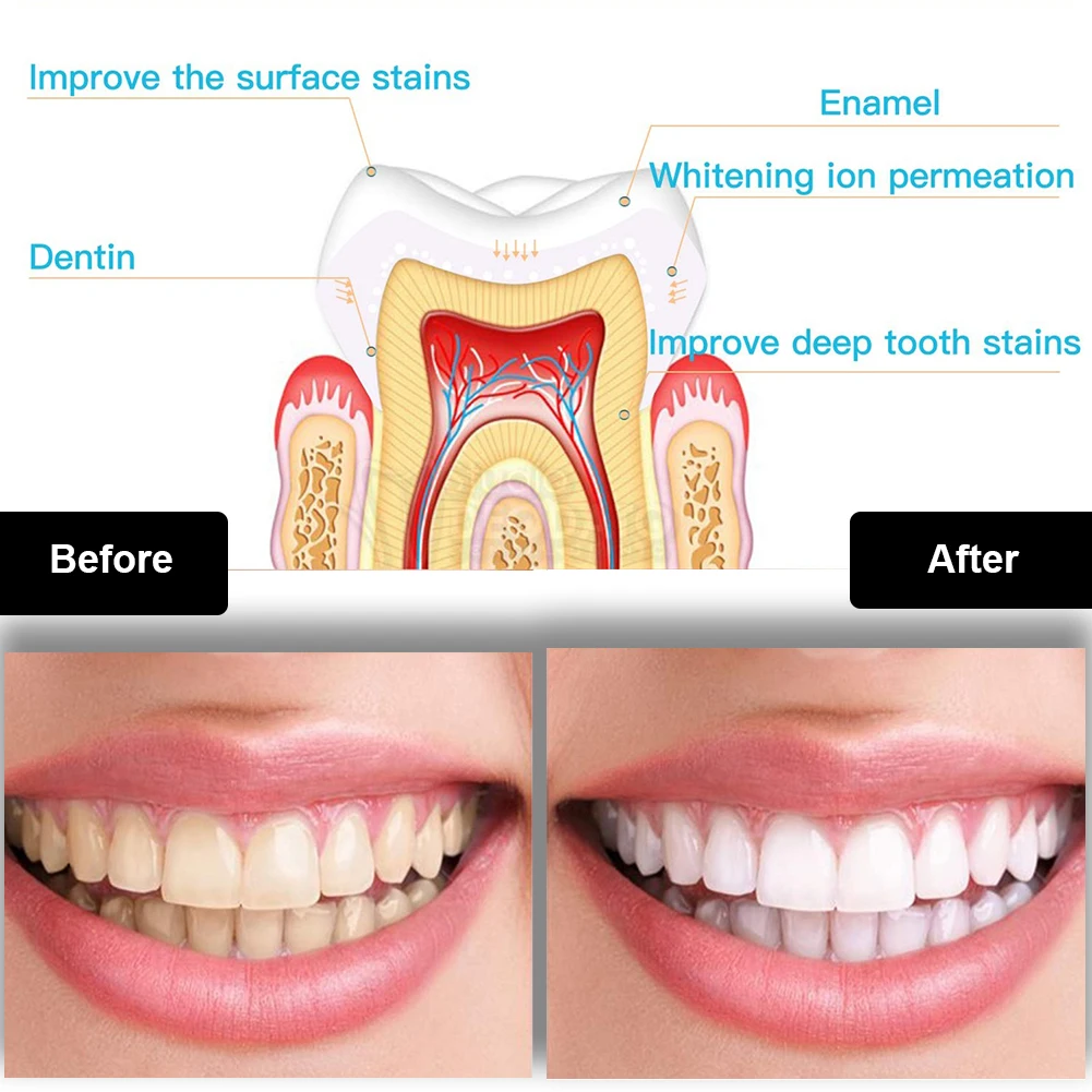Набор для отбеливания зубов, м – обзор и цена Teeth Whitening Kit With Light
